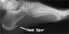 xray_foot_heelspur01.jpg